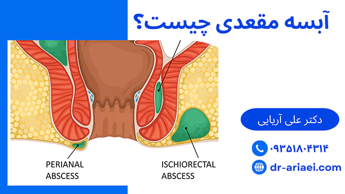 آبسه مقعدی چیست