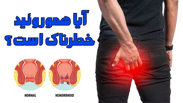 آیا هموروئید خطرناک است؟