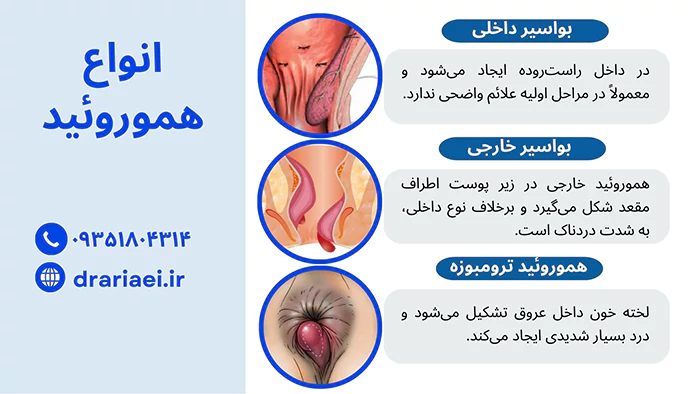 انواع بواسیر