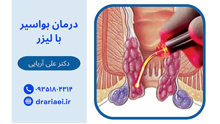 درمان بواسیر با لیزر