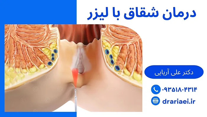 درمان شقاق با لیزر