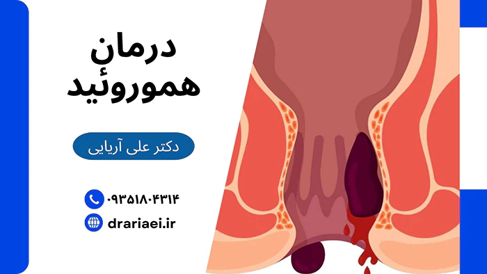 درمان هموروئید