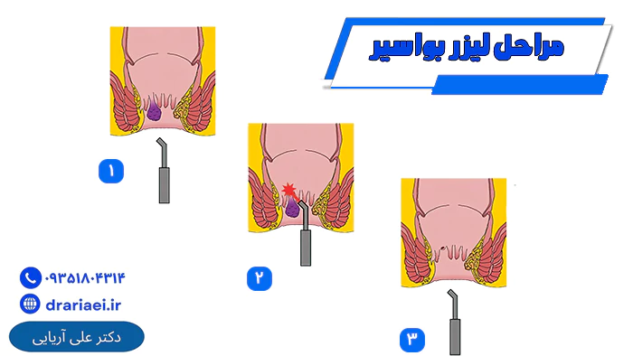 مراحل لیزر بواسیر
