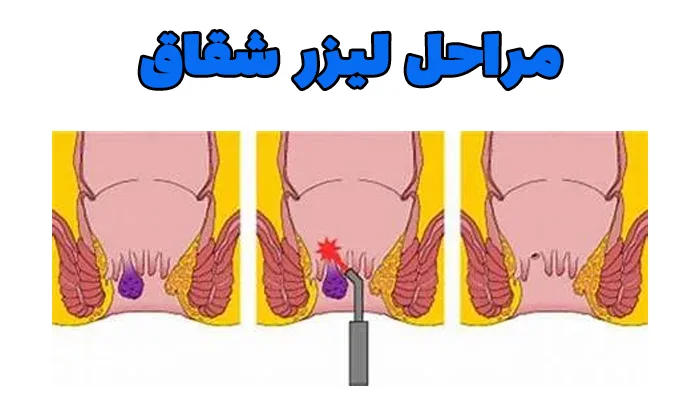 مراحل لیزر شقاق