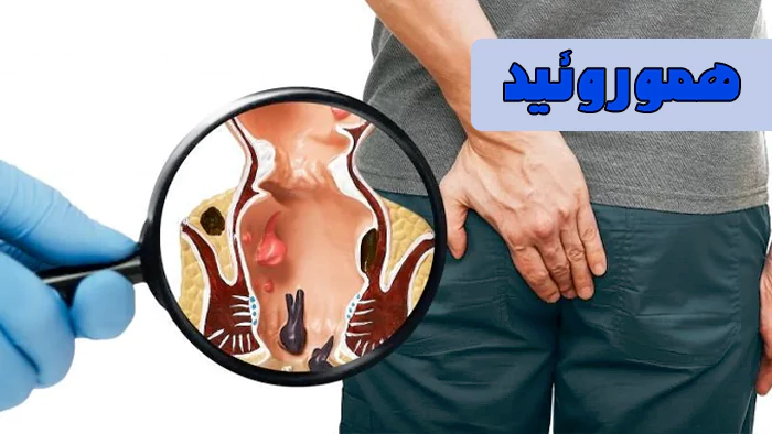 هموروئید چیست