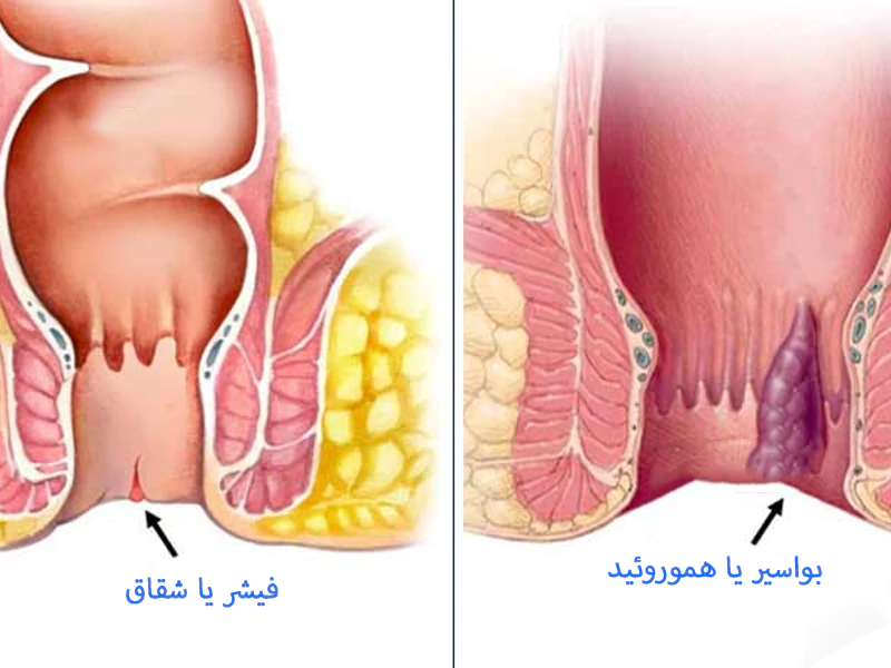 تفاوت شقاق با بواسیر