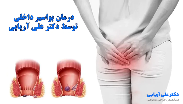 درمان بواسیر داخلی توسط دکتر علی آریایی