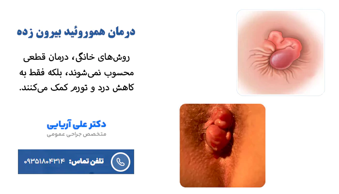 درمان خانگی هموروئید بیرون زده