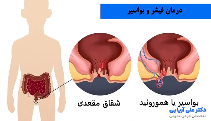 درمان فیشر و بواسیر