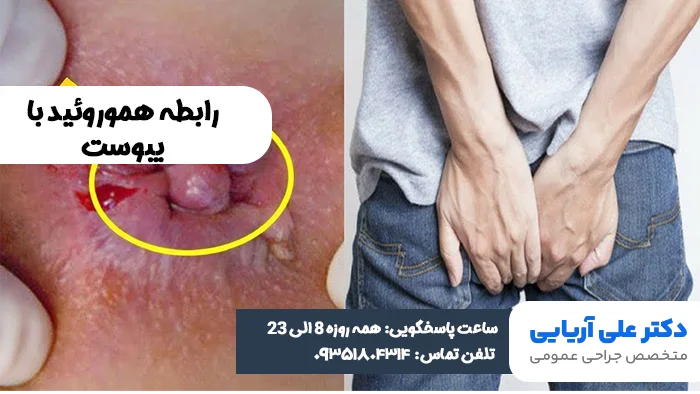 رابطه هموروئید با یبوست