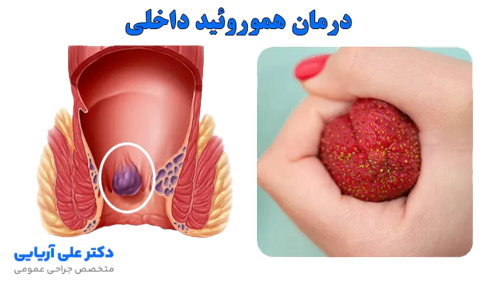 روش های درمان هموروئید داخلی