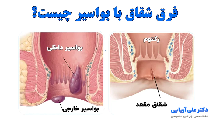 فرق شقاق با بواسیر