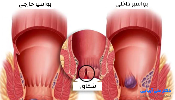 فرق هموروئید با فیشر