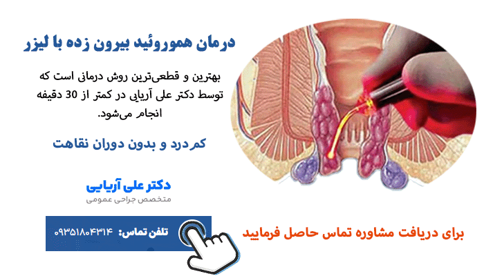 لیزر هموروئید بیرونی