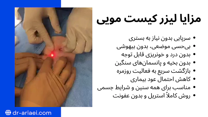 مزایا لیزر کیست مویی