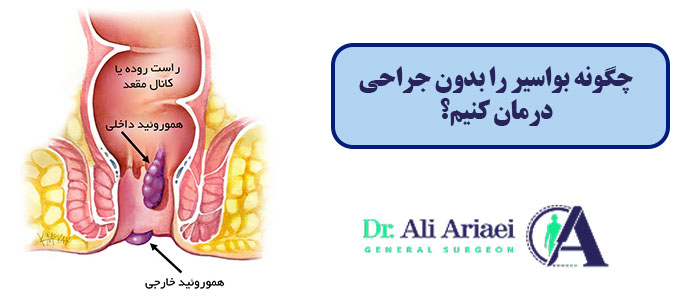 چگونه بواسیر را بدون جراحی درمان کنیم؟