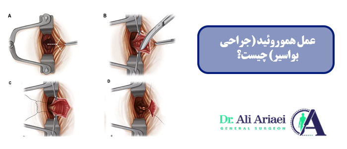 عمل هموروئید (جراحی بواسیر) چیست؟