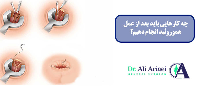 چه کارهایی باید بعد از عمل هموروئید انجام دهیم؟