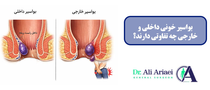 بواسیر خونی داخلی و خارجی چه تفاوتی دارند؟