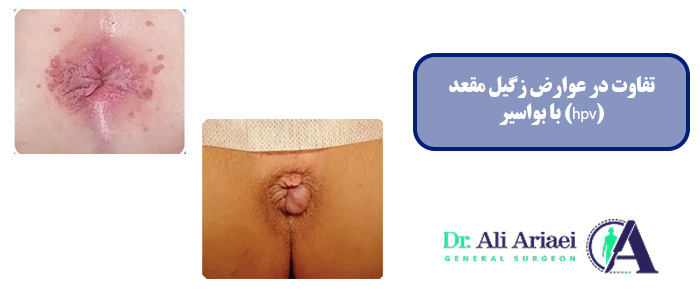 تفاوت در عوارض زگیل مقعد (hpv) با بواسیر