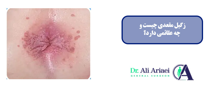 زگیل مقعدی چیست و چه علائمی دارد؟