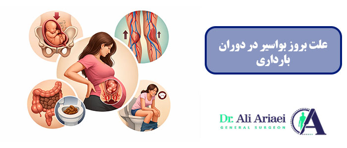 علت بروز بواسیر در دوران بارداری