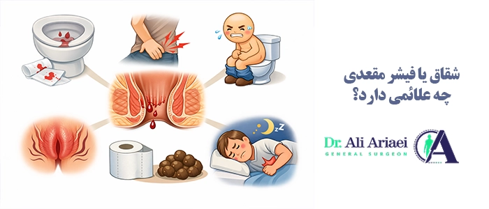 شقاق یا فیشر مقعدی چه علائمی دارد؟